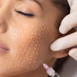 Биоревитализация что это?